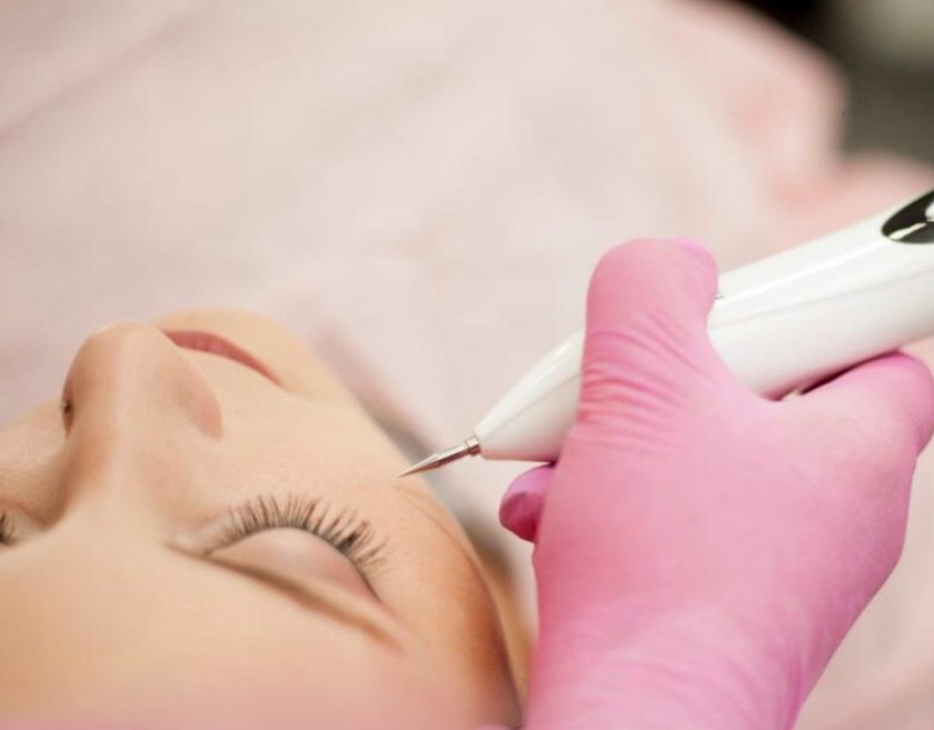 Caneta de jato de plasma aplicada ponto a ponto na pálpebra.