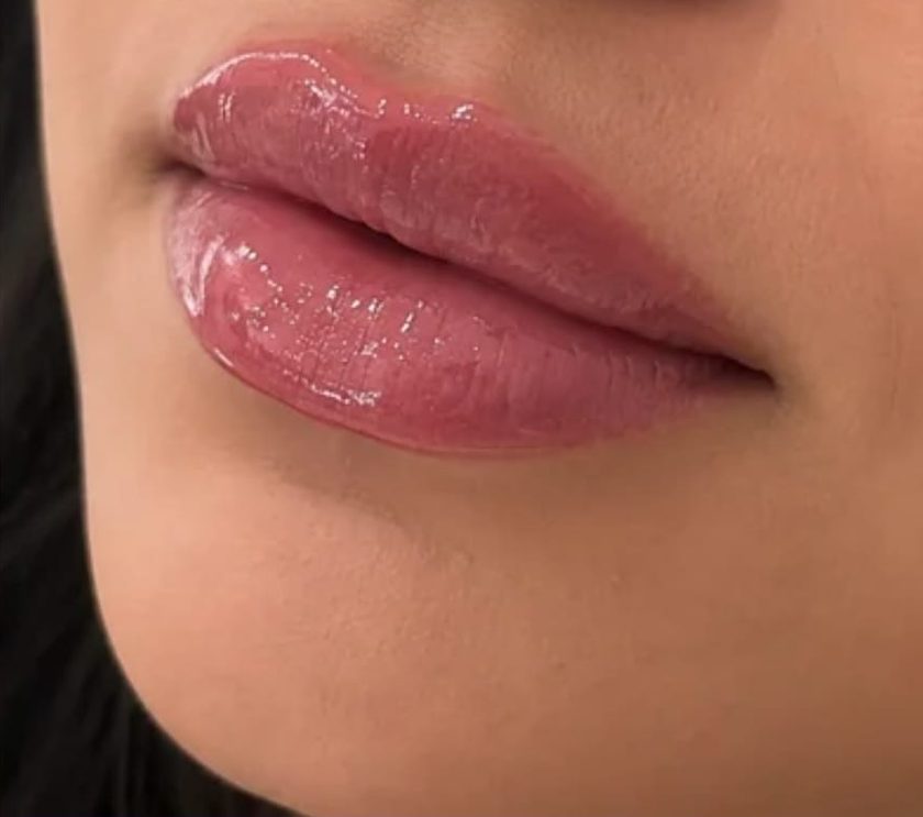 Close de lábios, região tratada pelo preenchimento labial.